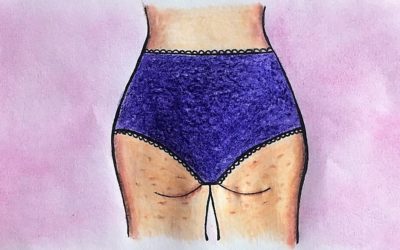 Tengo celulitis, ¡¿qué hago?!